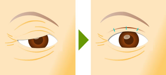 老人性眼瞼下垂手術イメージ