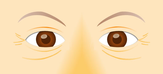 眼瞼下垂の手術後イメージ